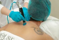 Technician in blue gloves using a laser device to remove a tattoo from a patient's upper back