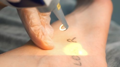 Why You Should Think Twice Before Trying At Home Tattoo Removal